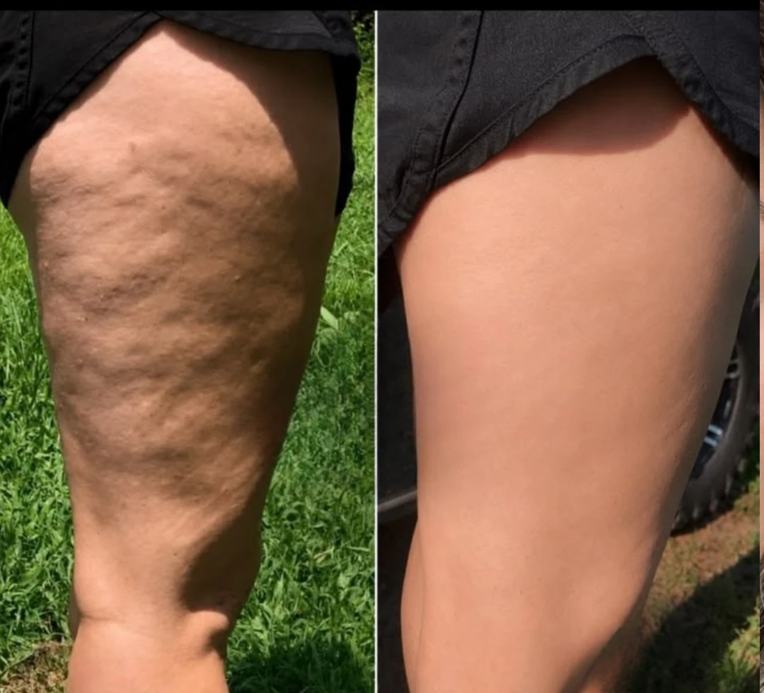 LipoSculpt customer review