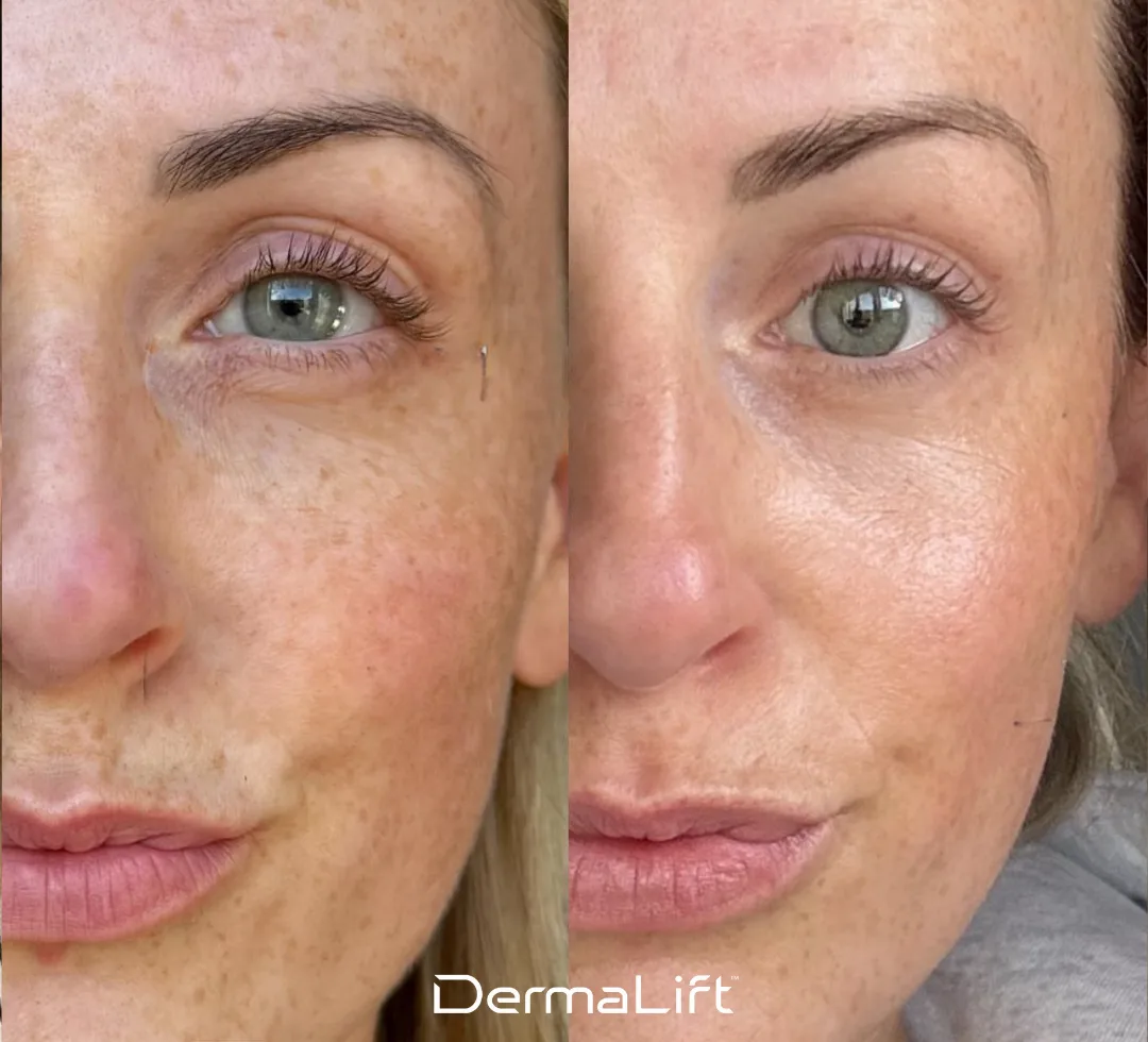 DermaLift Before And After